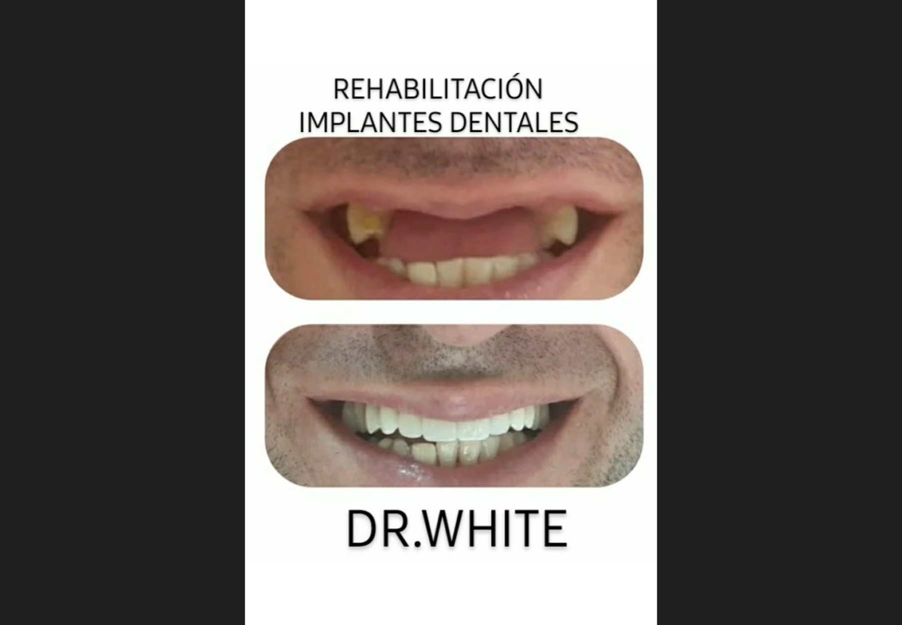Dr. White Implantes Dentales showing before-and-after dental implant and aesthetic restoration results with patient smiles.
